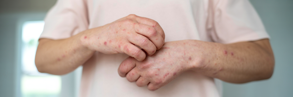 Adult eczema uncovered how to stop the itch and redness 1