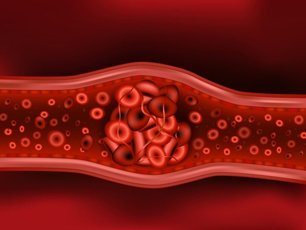 Blood clots
