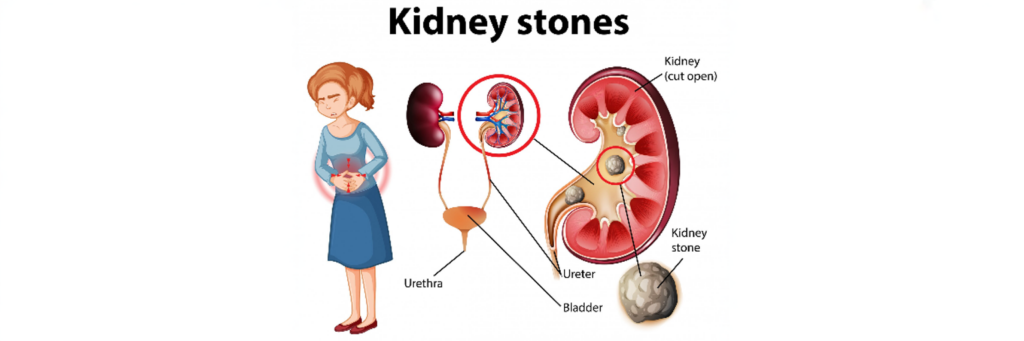 Breaking the stones effective treatments for large kidney stones