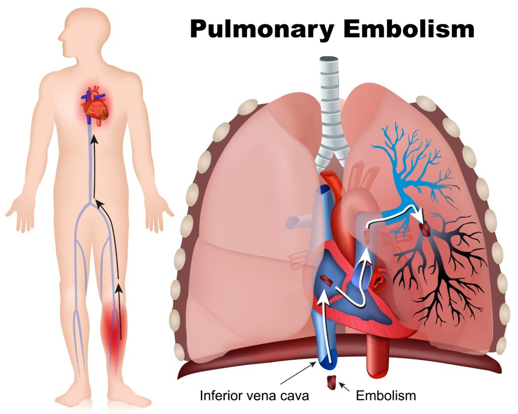 Pulmonary embolism & atherosclerosis: the link between blood clots and artery health 5 Athero