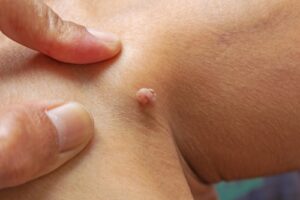 Doctor explaining treatment options for recurring fibromas, comparing injection therapy and surgical removal
