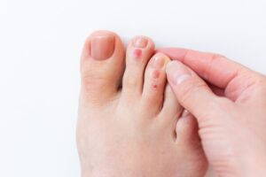 Close-up of a foot blister caused by friction from shoes, showing irritated skin and fluid-filled bubble on the heel. Foot blisters
