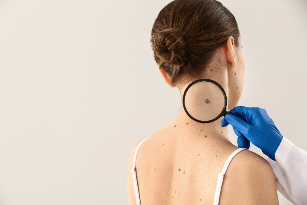 Melanoma 2 Shutterstock 1360237745