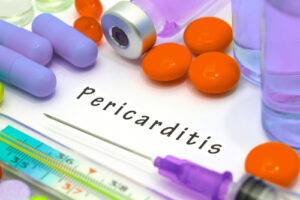 Medical illustration of acute pericarditis showing inflammation of the pericardium around the heart