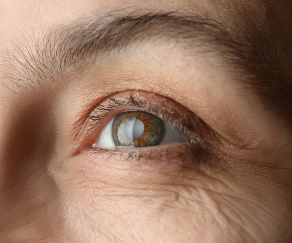 Cataract Surgery