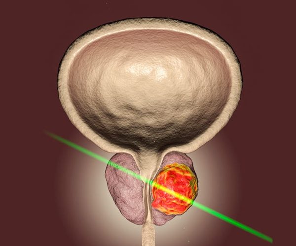 GreenLight Laser Therapy