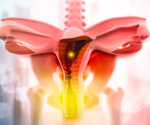 Hysterectomy