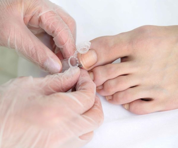 Nail Biopsy