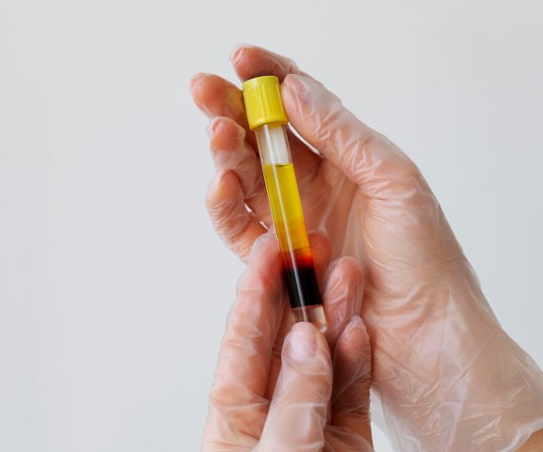 Plasmapheresis