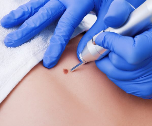 Removal,Of,Benign,Tumors,In,Cosmetic,Salon.,The,Use,Of