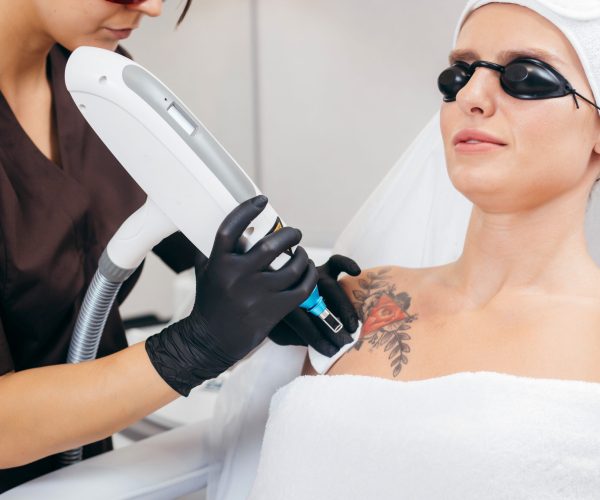 Laser,Tattoo,Removal,From,Shoulder