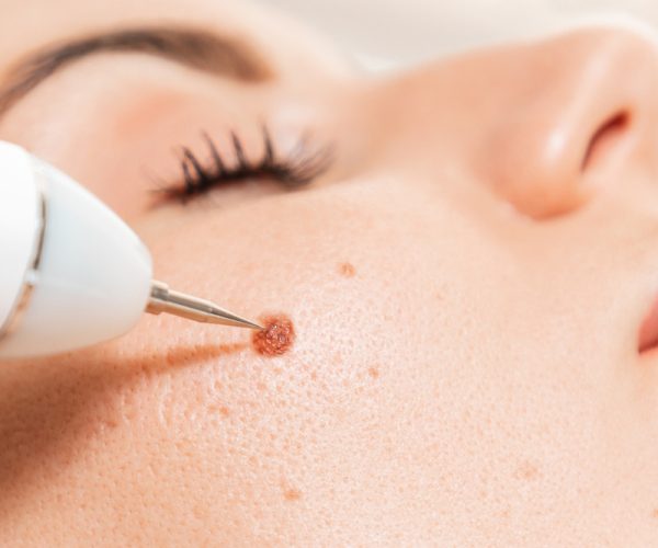 Microsurgery.,Removal,Of,Birthmark,From,Client's,Cheek,With,Laser,Device.