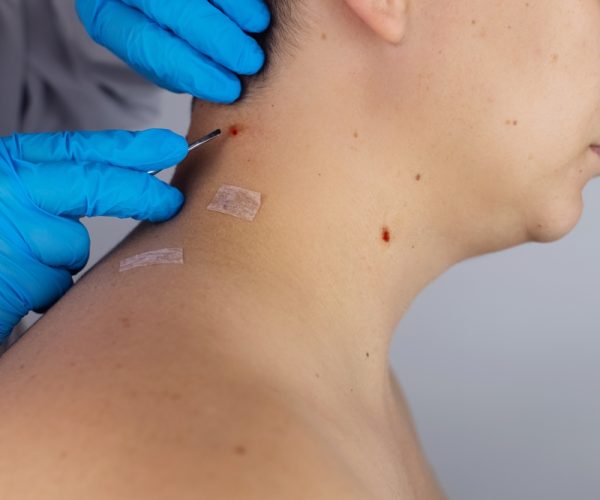 Close-up,Of,The,Wound,That,Remained,After,Excision,Of,The