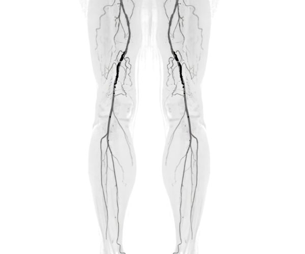 Cta,Femoral,Artery,Run,Off,Image,Of,Femoral,Artery,Presenting