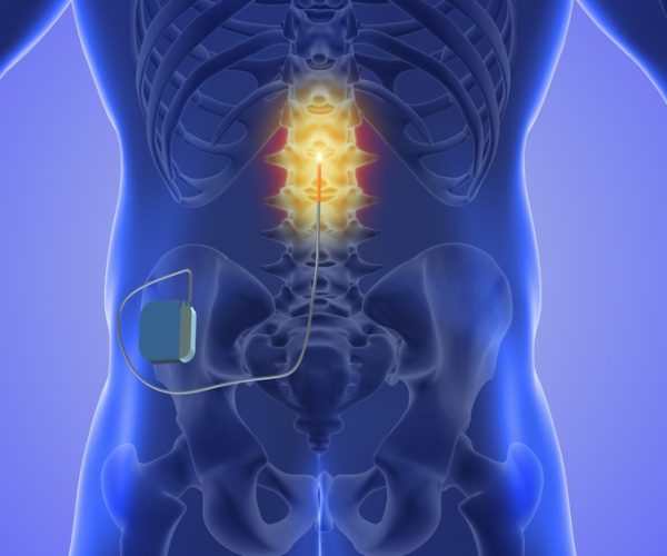 Injecting,Steroids,To,Treat,Herniated,Disc,Pain,3d,Illustration