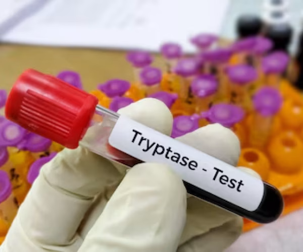 tryptase-test-tryptase-test-can-help-doctors-determine-if-severe-allergic-reaction-anaphylaxis_595440-2810